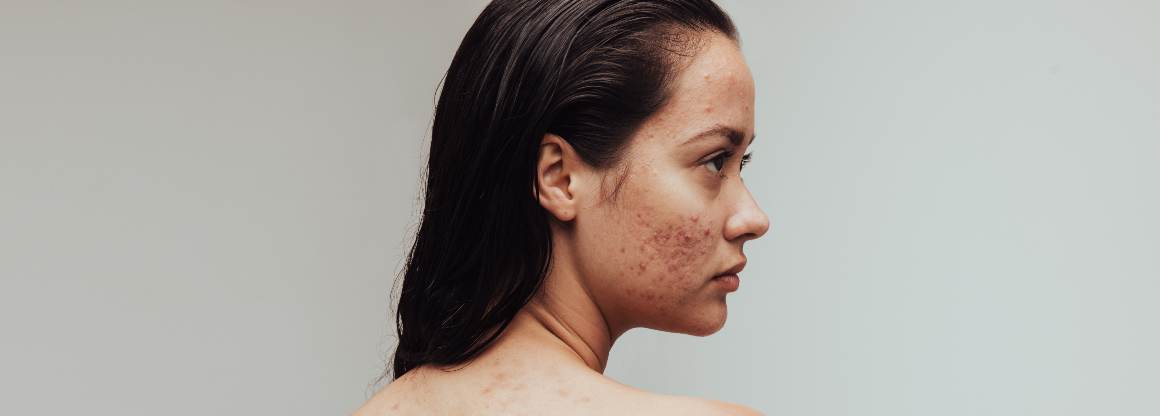 Quali alimenti causano l'acne? I 9 principali alimenti che causano l'acne